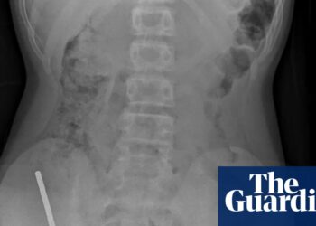 Surgeons take away as much as 100 magnets from New Zealand teenager’s intestines | New Zealand Surgeons take away as much as 100 magnets from New Zealand teenager’s intestines | New Zealand