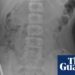 Surgeons take away as much as 100 magnets from New Zealand teenager’s intestines | New Zealand Surgeons take away as much as 100 magnets from New Zealand teenager’s intestines | New Zealand