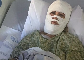 Chemical assault leaves Georgia girl hospitalized with third-degree burns Chemical assault leaves Georgia girl hospitalized with third-degree burns