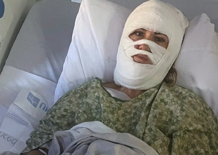 Chemical assault leaves Georgia girl hospitalized with third-degree burns