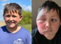 TikTok development leaves boy with extreme burns, docs concern warning