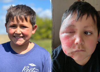 TikTok development leaves boy with extreme burns, docs concern warning