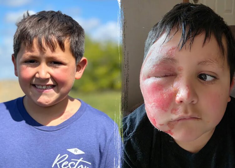 TikTok development leaves boy with extreme burns, docs concern warning
